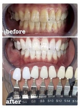 ピュアホワイトニング 横浜店/ホワイトニング/横浜/横浜駅