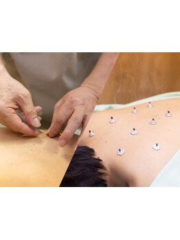 鍼灸施術を受けたい