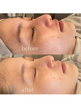 エムアンドユウ(m&u)/毛穴洗浄で肌質改善