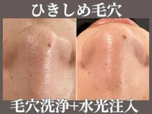 マヴィ 今福鶴見店(MavY.)/毛穴洗浄×水光注入