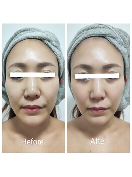 ビー アンド エイチ(B&H)/小顔＆リフトアップ（施術1回）