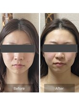 リノリー(rinory)/小顔矯正