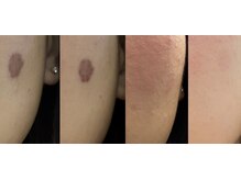 ルノン(LUNON)の雰囲気(今話題の7日間の集中シミケア導入!詳しくはブログへ♪)