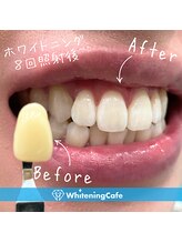 ホワイトニングカフェ 池袋東口店/ホワイトニングビフォーアフター