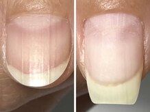 アルクネイル 成田(alku nail)/ 自爪育成　[成田/パラジェル]