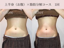 ミア(miiia)/上半身×脂肪分解コース　1回