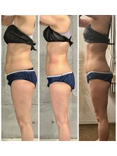 ドゥーソル 谷町四丁目店(due sole)/谷四/脂肪冷却2カップ×キャビ