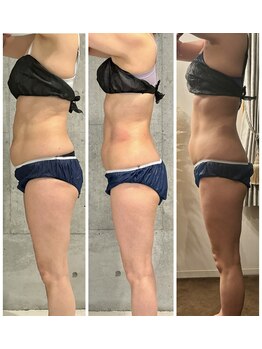 ドゥーソル 谷町四丁目店(due sole)/谷四/脂肪冷却2カップ×キャビ