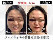 ポーベルポー(Peau Belle poe)/フェイシャル小顔矯正＋パック