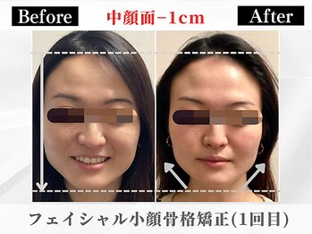 ポーベルポー(Peau Belle poe)/フェイシャル小顔矯正＋パック