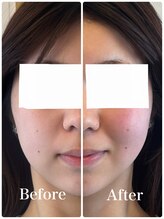 アンドグレイスプラス 恵比寿(&Grace+)/小顔＆レモンボトル