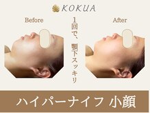 痩身専門店エステティックサロン コクア(KOKUA)の雰囲気（【ハイパーナイフ】お顔の脂肪分解＆老廃物スッキリ流す！）