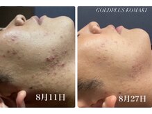 ゴールドプラス 小牧店(GOLD PLUS)/BeforeAfter
