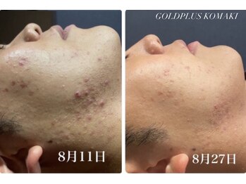 ゴールドプラス 小牧店(GOLD PLUS)/BeforeAfter