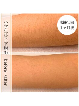 ココスターリー 香椎店(Coco starry)/キッズ・照射1回☆1ヶ月後