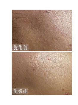 肌音色/■肌荒れ・頬の毛穴初回施術例。