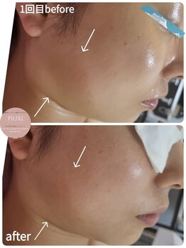 ピウリ(PIURI)/Before→After フェイスライン♪