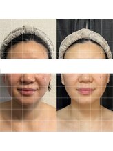 ジュエル シズオカ(JEWEL Shizuoka)/コルギBefore After