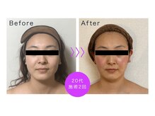 アンリール 旭川店(Anrire)/フェイシャル施術のお客様です！