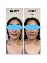 パルフェ(THE Parfait)/大満足の小顔矯正