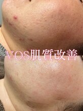 ティアーナ(Tiaana)/肌質改善VOSサロンケア