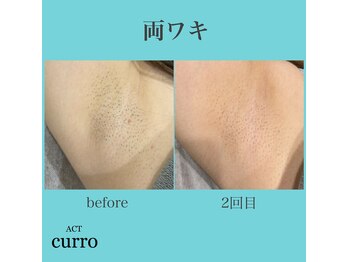 アクト クロ(ACT curro)/【うなじ襟足】脱毛施術例