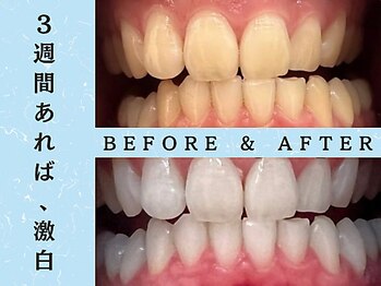 ホワイトニングショップ 八王子店/ホワイトニングビフォーアフター