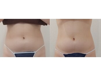 クレール アオヤマ(CLAIRE AOYAMA)/【1回】内臓脂肪・たるみ効果大