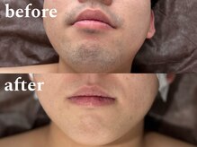 ボス 津店(BOSS)/【メンズ脱毛/ヒゲ脱毛】