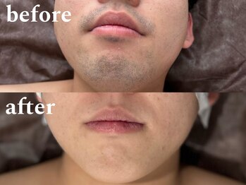 ボス 津店(BOSS)/【メンズ脱毛/ヒゲ脱毛】