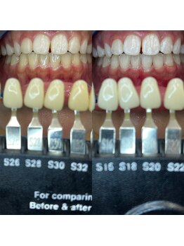 トウキョースワーズ 渋谷店(TOKYO SWRS)/#ホワイトニング #渋谷 #池袋
