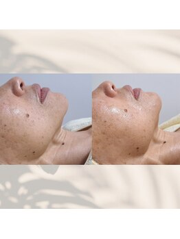 エミナル バイ ニコドット(Eminal by nico.)/フェイシャル小顔・筋膜リリース