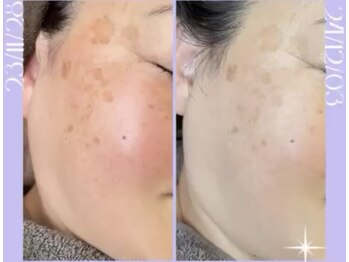 リラクゼーションサロン ラキ(laki)/スキンメイド/トロイアルケ