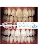 ホワイトニングサロン 福岡天神店/ホワイトニング