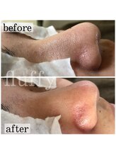 フラフィ 宇都宮本店(fluffy)/黒ずみはもう諦めてました！