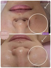 ピウリ(PIURI)/Before→After 毛穴スッキリ改善