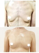 デミーナ(Demyna)/【バストアップ・育乳】症例