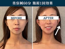 シンク(CINQ)/美容鍼灸90分肩こりリフトアップ