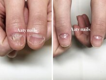 アーティネイルズ(Aaty Nails)/ハンド深爪矯正