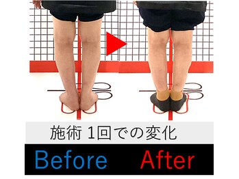 池袋東鍼灸整骨院/O脚矯正