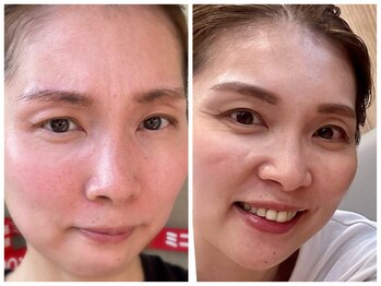 エミナル(eminal)/ビフォー/アフター/毛穴/梅田