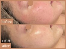 リムーン 岡崎(Re'moon)/REVI ハーブピーリング