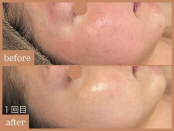 リムーン 岡崎(Re'moon)/REVI ハーブピーリング