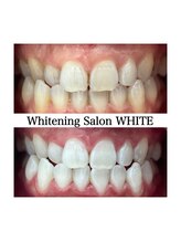 ホワイトニングサロン ホワイト 天童店(WHITE)/当店自慢のホワイトニング