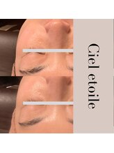 シエルエトワレ/CIVASAN シルク肌コース