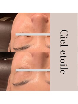 シエルエトワレ/CIVASAN シルク肌コース