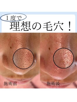 ラデュープラス(Radieux+)/【韓国式3D毛穴洗浄】前後