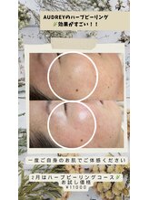 オードリー(Audrey)/ハーブピーリング大人気です！