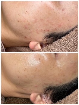 ホワイトアクア 天王寺本店(WHITE AQUA)/ララピール/大阪/天王寺/小顔