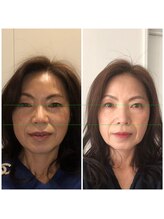 ハーボプラス(THE HEARBO plus)/初回　翌日